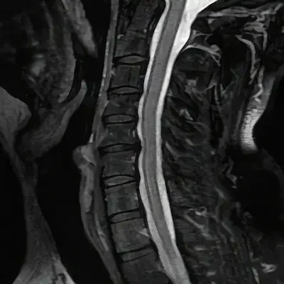 Spinal cord injury attorney services for catastrophic injury victims in Massachusetts